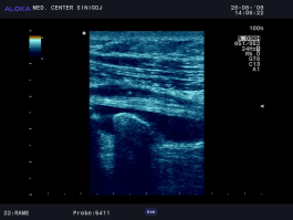 Ultrazvok rame - kalcinirajoči peritendinitis tetive bicepsa s tekočinskim plaščem, vzdolžno